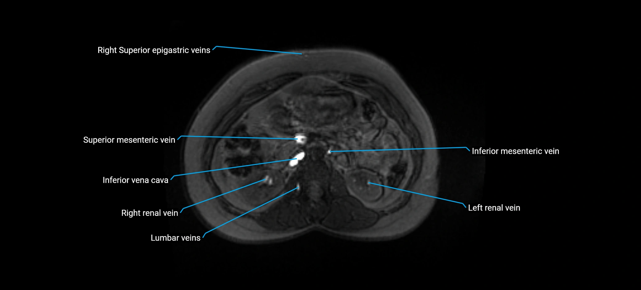 MRV abdomen pelvis & lower limb axial cross sectional anatomy labelled MRI image 74 (1).webp